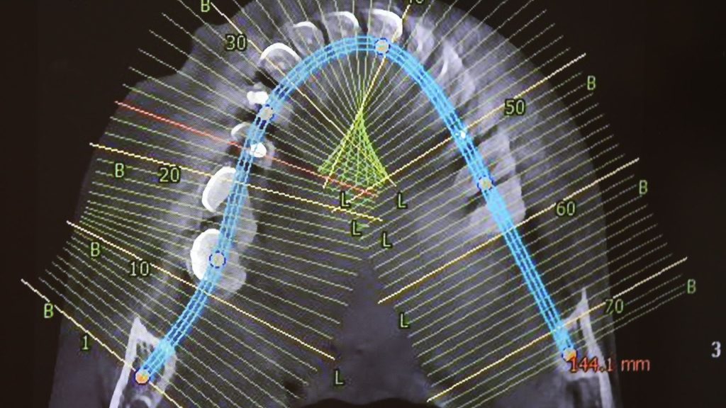 Planificarea digitală a implantului dentar pe CBCT la Ki Dental Clinic