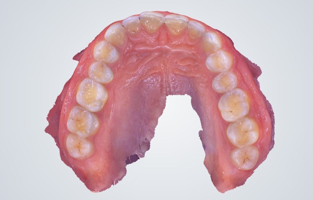 Scanare intraorală 3D la Ki Dental Clinic