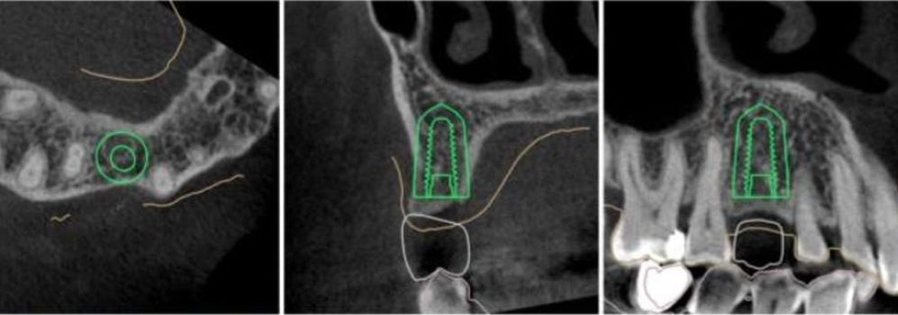 Planificare digitală a implantului dentar pe CBCT la Ki Dental Clinic